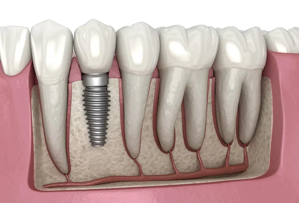 Ilustração de implante com coroa substituindo um dente